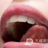 出现舌扁平苔藓的原因有哪些