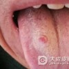 怎样预防舌扁平苔藓较有效呢