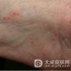 患了汗疱疹应该怎样治疗