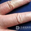 汗疱疹怎么治疗效果好呢