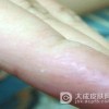 汗疱疹的危害都有哪些呢