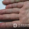 汗疱疹怎么治疗效果才好呢