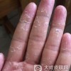 手癣怎么才能彻底治愈