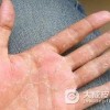 你知道手癣治疗的较好方法