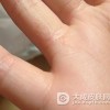 患上了手癣可以做家务吗