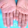 手癣到底会传染吗
