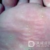 如何有效的预防跖疣的发生