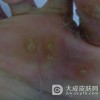 跖疣的日常预防情况介绍