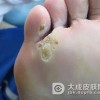 怎样预防跖疣