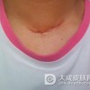疤痕到底是如何产生的呢
