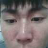 皮肤过敏在饮食上要注意什么