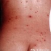 水痘的治疗方法