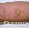 什么叫是脓疱型银屑病呢
