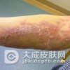 脓疱型银屑病的患者治疗前的注意事项