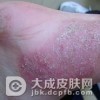 脓疱型银屑病的相关常识都有哪些呢
