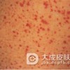 银屑病与神经性皮炎有什么区别