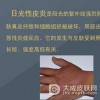 日光性皮炎治疗要点有哪些呢