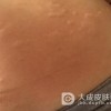 治疗痒疹应注意什么