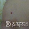 关于鲜红斑痣患者注意饮食
