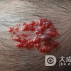 鲜红斑痣的患者的饮食该注意事项是什么
