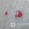 平时爱吃辣会加重鲜红斑痣的颜色吗