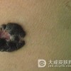 恶性黑色素瘤的病理分型是什么呢