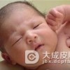 肠病性肢端皮炎的基本的护理
