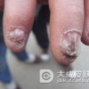 关于肠病性肢端皮炎的护理方法