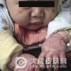 肠病性肢端皮炎到底怎么办