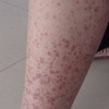 过敏性紫癜治疗前需要做哪些检查