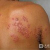 汗疱疹诊断的要点