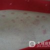 玫瑰糠疹的危害主要有哪些