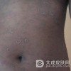 玫瑰糠疹对人体的危害