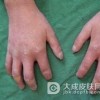 专家为您详解局限性硬皮病