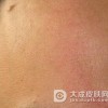 局限性硬皮病的中医辨证法有哪些