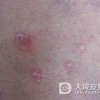 女性多发红斑狼疮的原因