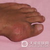 如何来预防痛风好呢