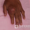 痛风的症状表现是什么
