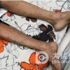 艾滋病症状主要的有哪些