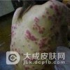 患了艾滋病有那些明显的症状？