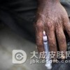 艾滋病的症状特征主要是什么呢