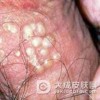 生殖器疱疹的治疗误区有哪些