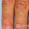 皮肌炎护理注意事项