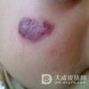 蔓状血管瘤如何治疗