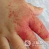 蔓状血管瘤应该怎么办呢