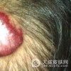 蔓状血管瘤的面部治疗