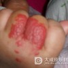 婴儿蔓状血管瘤是否可以治愈呢