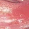 念珠菌感染引起口腔粘膜白斑