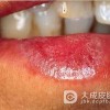 舌扁平苔藓的危害表现在哪些方面