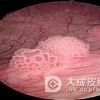 关于外阴软纤维瘤的治疗